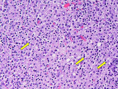 Histiocytes with basophilic Michaelis–Gutman bodies (yellow arrows).