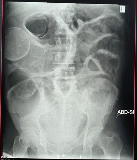 Plain abdominal X-ray showing dilated bowel loops.