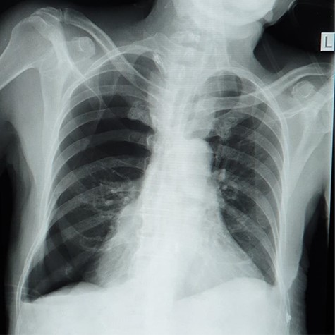 Chest X-ray showing right-sided pneumothorax with thoracostomy tube.