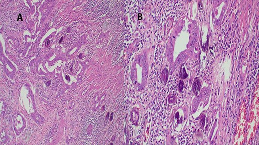 (A) Histopathology of colon with adenocarcinoma associated with Schistosoma ova with poorly formed granulomatous inflammation, hematoxylin and eosin (H&E) ×20 magnification. (B) Adenocarcinoma and Schistosoma ova with dense lymphocytic infiltrates ×40 magnification.