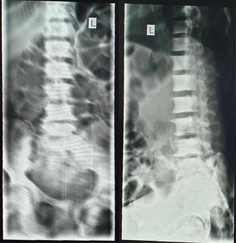Spine X-ray showing lytic lesions.