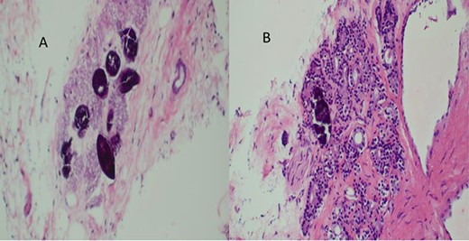 (A) Histopathology of prostatic trucut core biopsy showing infiltrating adenocarcinoma and Schistosoma ova, H&E ×4, ×10 magnification. (B) Prostatic adenocarcinoma and Schistosoma ova, ×40 magnification.