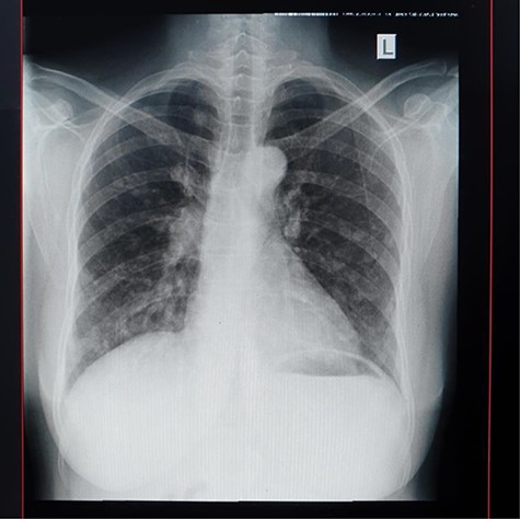Plain chest X-ray with macronodules.