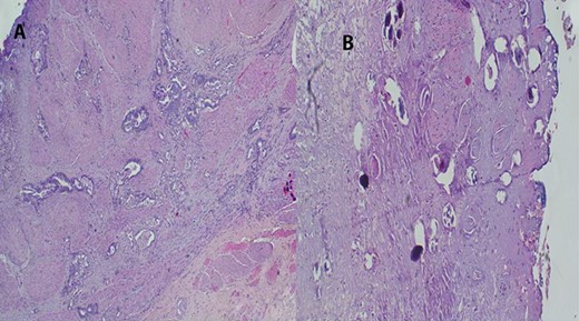 (A) Histopathology of urinary bladder with invasive adenocarcinoma, not otherwise specified (NOS), H&E ×10 magnification. (B) Schistosoma ova near or within the tumor, ×4 magnification.
