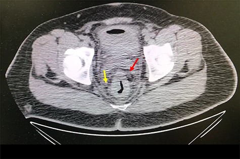 Axial abdomen and pelvis CT scan showing enlarged lymph nodes (yellow arrow) and fat standing around rectum (red arrow).