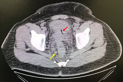 Axial abdomen and pelvis CT scan showing fistulous tract adjacent to the proximal rectum and the bladder (red arrow) and enlarged lymph nodes (yellow arrow).