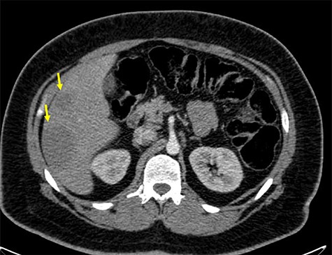Axial abdomen and pelvis CT scan showing hepatic hypodense lesion and possible liver metastasis (yellow arrow).