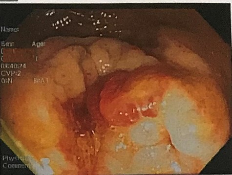 Colonoscopy results showing a large, irregular, friable concentric lesion occluding 95% of the lumen, 20 cm from the anal verge.
