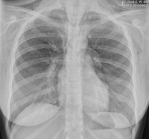 Chest X-ray demonstrating pneumomediastinum with associated subcutaneous emphysema.