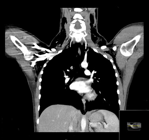 Coronal CT demonstrating extensive surgical emphysema in the neck, supraclavicular fossae, axillae and upper chest wall with moderate pneumomediastinum.