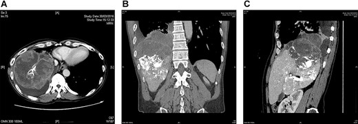 CT showing a large hepatocellular carcinoma invading through diaphragm into lung base. (A) axial view, (B) coronal view and (C) sagittal view. Hyperdense material within liver is lipiodol deposits after previous TACE.