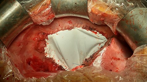 Operative view showing the diaphragmatic defect closed with Goretex mesh.