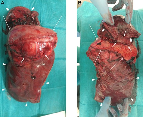 Resected specimen showing right lobe of liver (arrow heads), diaphragm (long arrows), tumor (median arrows) and resected lung tissue (short arrows). (A) Lateral view and (B) medial view.