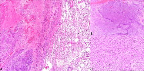 Histological findings. (A) Tumor invading into lung parenchyma, (B) tumor arranged in solid sheets (×40) and (C) tumor cells of the poorly differentiated hepatocellular carcinoma (×200).