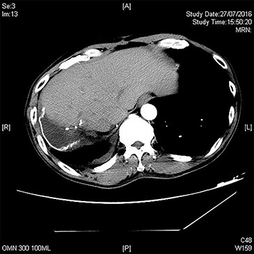 Follow-up CT showing hypertrophied left liver without recurrence.