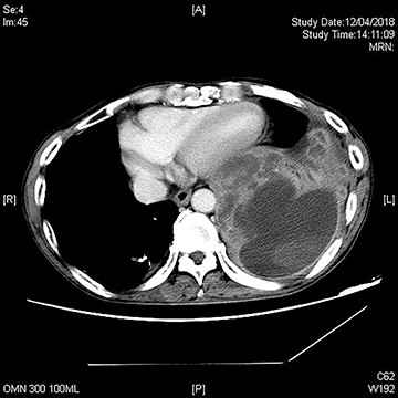 CT showing recurrence at left lower lobe of lung.
