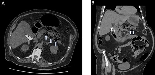 (A) Axial non-contrast CT scan of the abdomen and pelvis highlighting the interstitial air within the pancreas (white arrows) and multiple calcified gallstones within the gallbladder (black arrows). (B) Coronal view of the same scan.