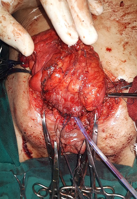 Augmentation of the bladder using the dilated sigmoid.