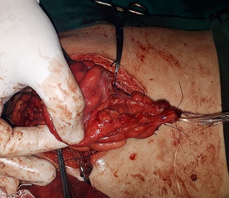 A cystostomy tube depending on Monti’s procedure by using a part of the augmented bladder.