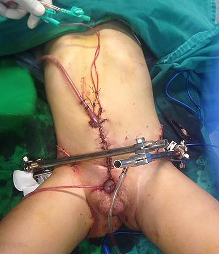 Immediately after surgery.