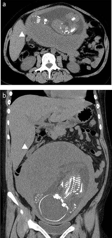 Preoperative CT scan; the swollen appendix (arrows) was translocated to the upper abdomen, and it can be observed underneath the liver, near the gallbladder; (a) axial view, (b) coronal view.