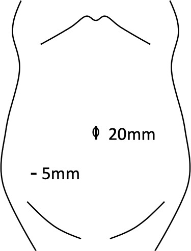 Placement of the EZ-access device and trocar.