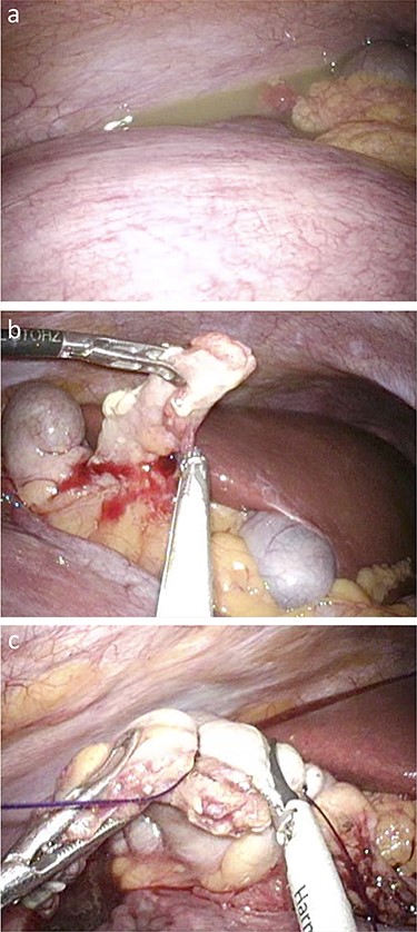 Operative findings; (a) the growing uterus with fetus, which pushed up the ileocecum under the liver, and the drain for pus collection; (b) dissection of the mesoappendix with laparoscopic coagulating shears; (c) dissection of the appendix after ligating the appendix base.