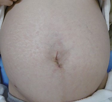 Operative scar 6Â weeks after surgery (at 33Â weeks gestational age).