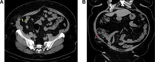 (A) Axial view of CT abdomen and pelvis demonstrating Spigelian hernia with an abdominal wall defect through all three layers of abdominal wall (yellow arrow); (B) coronal view of the same scan demonstrating the appendix herniating through the defect in hernial sac (red arrow).