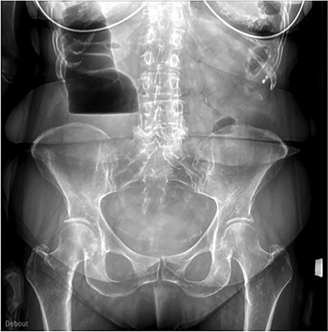 Abdominal X-ray on admission.