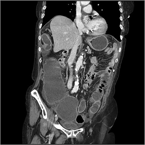 : CT scan images demonstrating a right diaphragmatic hernia containing intestine.
