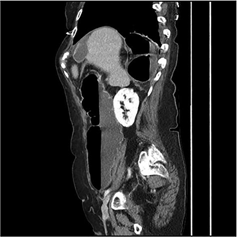 CT scan images demonstrating a right diaphragmatic hernia containing intestine.