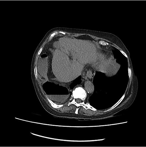 CT scan images demonstrating a right diaphragmatic hernia containing intestine.