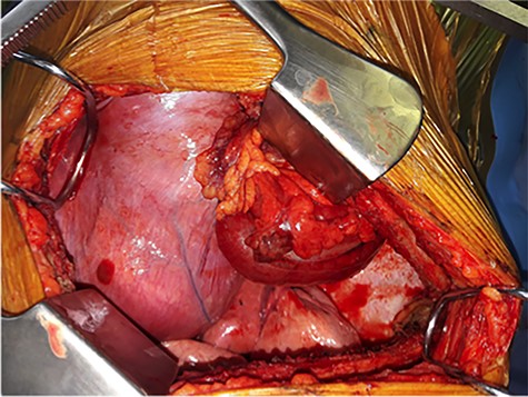 Per-operative pictures, before reduction of the content of the hernia.