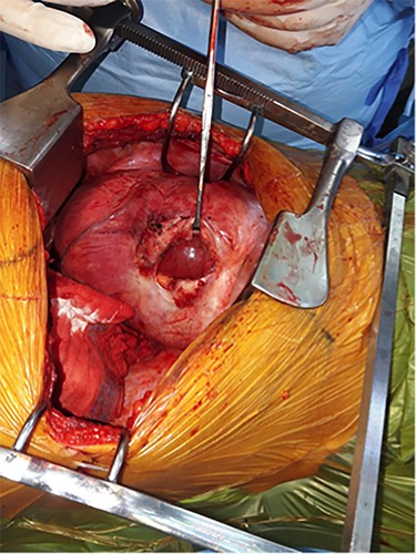 Per-operative pictures, after reduction of the content of the hernia.