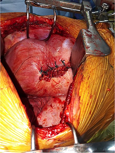 Per-operative pictures, after closure of the diaphragm with pledgets.