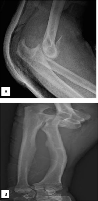 (A) X-ray of elbow profile shows the posterior elbow dislocation with a detached anterior fragment from the coronoid; (B) three-fourth X-ray of the forearm before the reduction demonstrates significant ulnar negative variance.