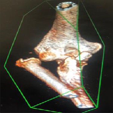 3D reconstruction CT scan of the elbow shows a radioulnar proximal dislocation with O’Driscoll type 2-2 anteromedial fracture.