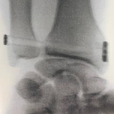 Anteroposterior X-ray of the wrist showing the DRUJ reduction and the TightRope stabilization.