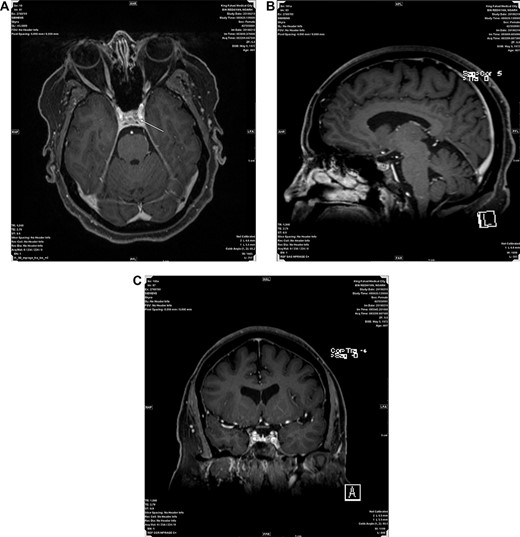 (A, B and C) Represent post contrast Axial, Sagital and Coronal MRI images respectively, showing a small non enhancing nodule in left side of adenohypophysis measuring 5.5 mm suggestive of microadenoma.