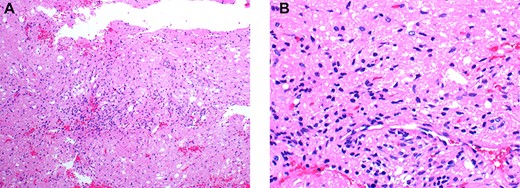 (A&B) Histopathological examination of the pituicytoma specimen shows elongate, bipolar spindle cells arranged in a fascicular and storiform patterns with no significant nuclear pleomorphism,mitotic activity and necrosis.