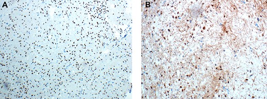 (A&B) Immunohistochemical examination of the pituicytoma specimen shows strong and diffuse nuclear staining for TTF-1 (Figure 3A), and rare cells shows positive staining for S100 (Figure 3B).