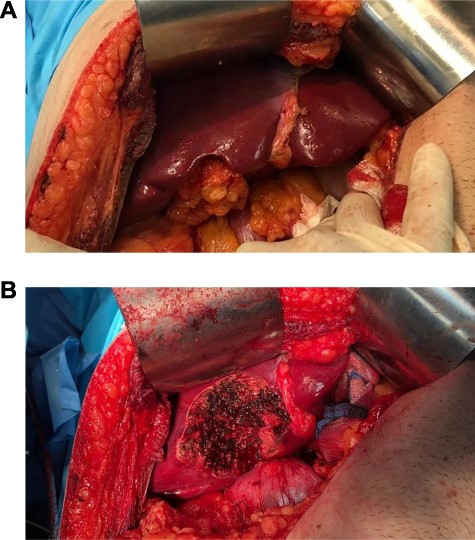 Intraoperative photograph before (a) and after (b) resection of the gallbladder fossa and lymphadenectomy.
