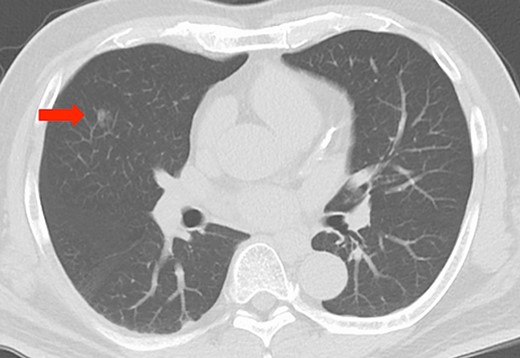 Imaging findings, chest computed tomography scan revealing a ground glass nodule, approximately 10 mm in diameter, in the right middle lobe (red arrow).