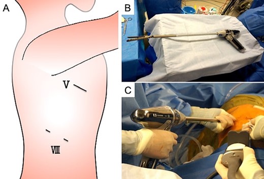 Thoracoscopic biopsy findings, (A) a 3-cm utility thoracotomy was performed at the fifth intercostal space (ICS) in the posterior axillary line. An 8-mm camera port and a 12-mm assisted port were placed at the eighth ICS in the middle axillary line and in the anterior axillary line, respectively. The line marked with ‘V’ indicates the fifth ICS; ‘VII,’ the eighth ICS. (B) The long-shaft stapler (LSS) attached with a Signia™ adapter XL (Covidien Japan, Tokyo, Japan) to the Signia™ Stapling System (Covidien Japan, Tokyo, Japan). (C) The nodule was removed via right middle wedge resection using the LSS from the assistant port at the eighth ICS.