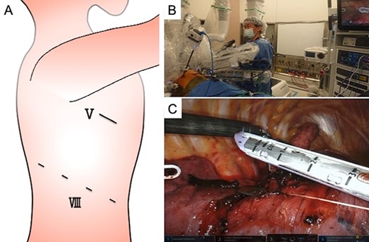 Robotic-assisted thoracoscopic surgery (RATS) findings, (A) a 4-arm RATS right middle lobectomy was performed, leaving a 3-cm utility thoracotomy, using the da Vinci® Xi (Intuitive Surgical, Sunnyvale, CA, USA). The line marked with ‘V’ indicates the fifth intercostal space (ICS); ‘VII,’ the eighth ICS. (B) An assistant used the long-shaft stapler (LSS) (Signia™ stapling system with Signia™ linear adaptor XL, Covidien Japan, Tokyo, Japan) from the utility thoracotomy during RATS lung resection. (C) The fissure between the right upper and middle lobe was divided from the utility thoracotomy using the LSS.