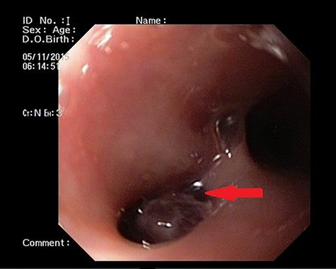 UGI endoscopy showing esophageal diverticulum (red arrow).