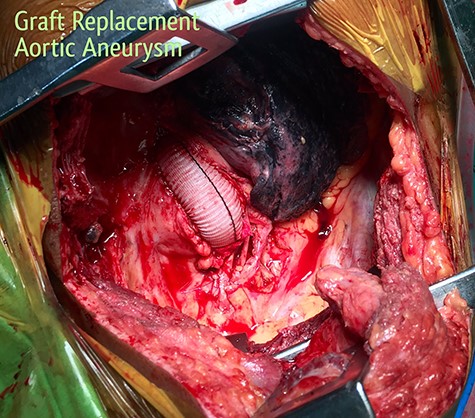 Replacement of the aneurysmal segment of the descending thoracic aorta with a Dacron graft, under partial bypass.