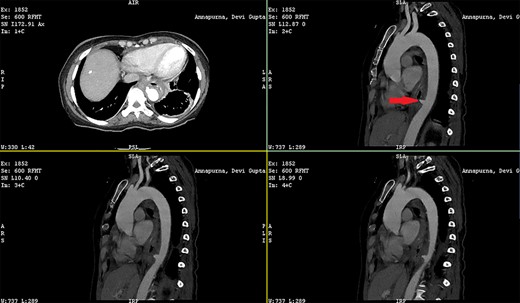 CECT showing the aorto-esophageal communication (red arrow).