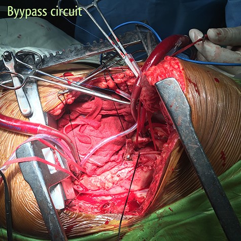 Partial bypass circuit. Outflow cannula is located in the aortic arch between the left common carotid artery and the left subclavian artery; inflow cannula is located in the descending thoracic aorta just above the diaphragm.